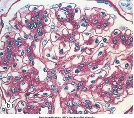 b, Diffuse glomerular lesion: widespread mesangial expansion (periodic acid Schiff). Ritz E.