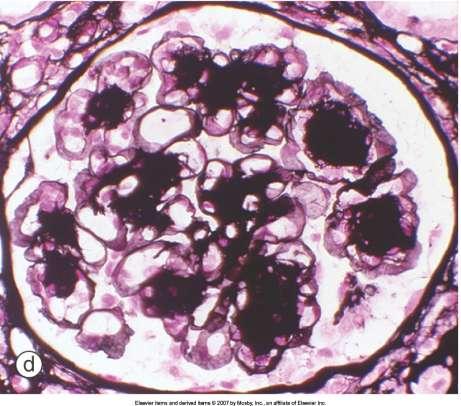 acid Schiff). d, Nodular lesion: methenamine silver staining showing the marked nodular expansion of mesangial matrix. Ritz E.