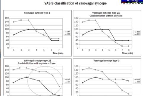 PACING IN NMS In adults