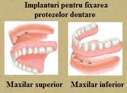 Componentele sistemului magnetic Avantaje - asigură o retenţie bună a protezelor dentare; - permit detaşarea cu uşurinţă a protezelor dentare; - respectă normele de protecţie biologică la câmp