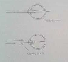 ακτινών. Οι ακτίνες δεν μπορούν να εστιάσουν πάνω στον αμφιβληστροειδή και το είδωλο σχηματίζεται πίσω. Η υπερμετρωπία διορθώνεται τοποθετώντας έναν θετικό (κυρτό) φακό (εικόνα 10).