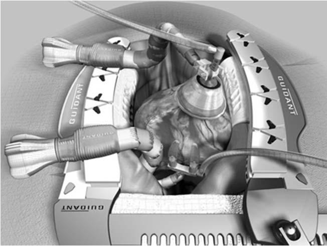 Off-Pump CABG Παρουσίαση