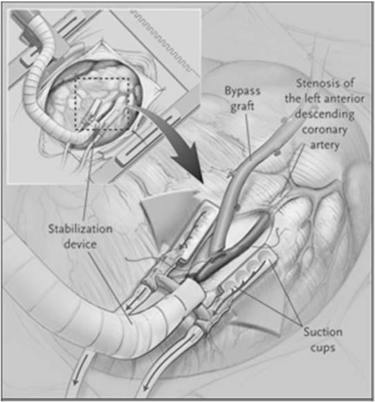 Off-Pump CABG