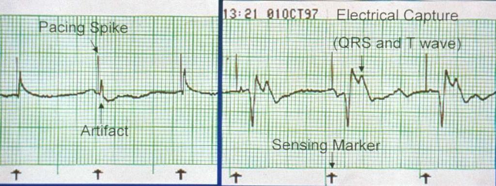 Transkutani pacing -Električni