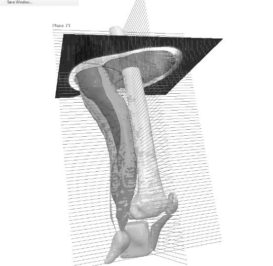 Τα άτοµα τοποθετήθηκαν στην κλίνη εισόδου στο µαγνητικό τοµογράφο. Το δεξί πόδι σηµαδεύτηκε στο οριζόντιο επίπεδο µε τη βοήθεια µοιρογνωµονίου.