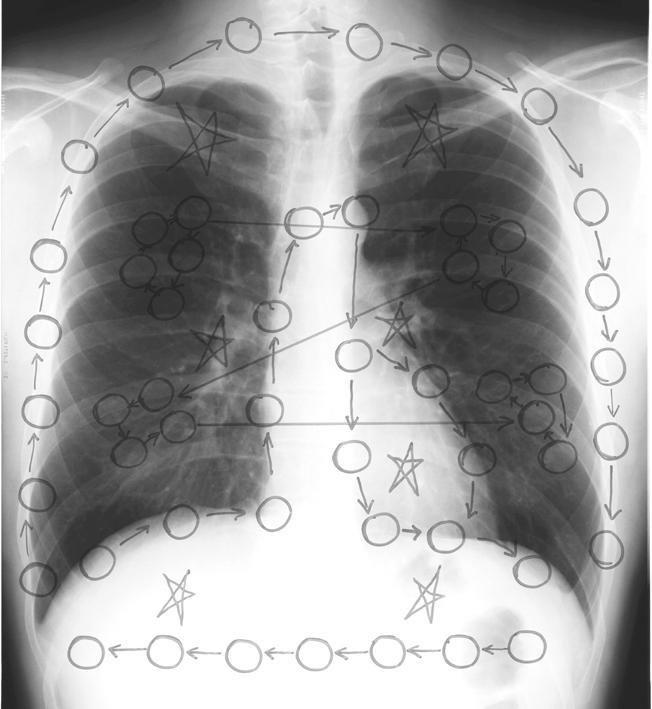 Frontal Chest X-Ray A