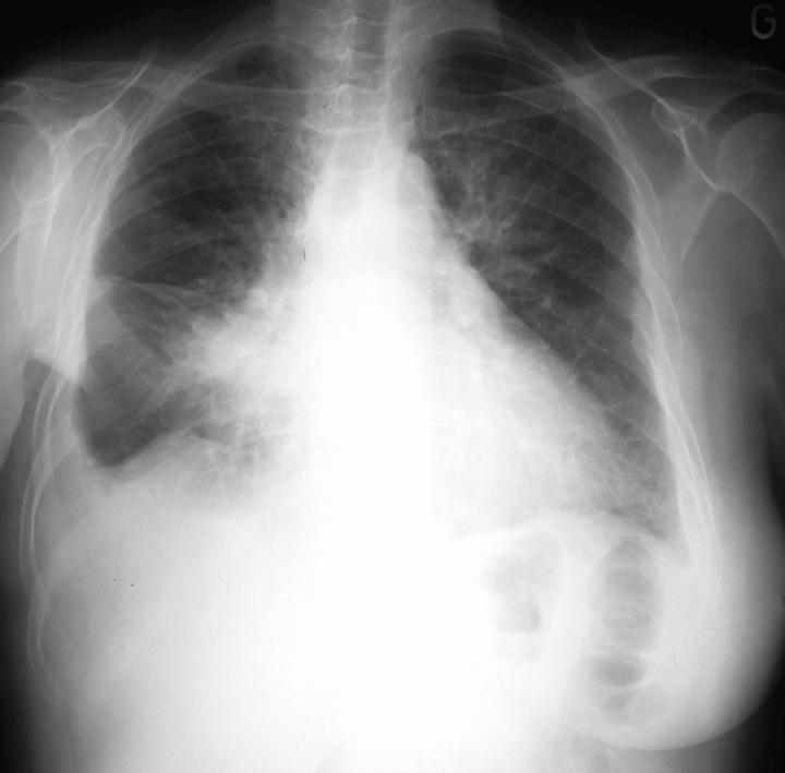 Frontal Chest X-Ray Cardiomegaly first comes to mind, BUT DID YOU NOTICE The right mastectomy?