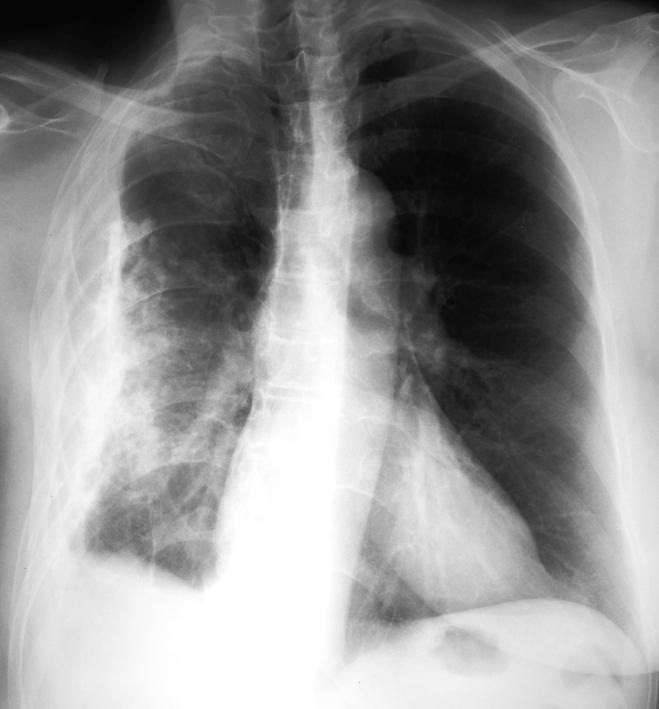 Frontal Chest X-Ray Right lateral calcification due to pleural