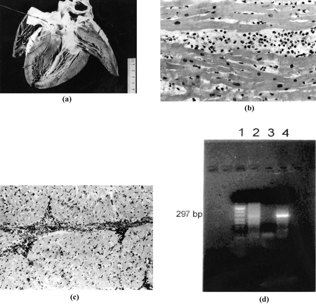 A 17-year-old, previously asymptomatic, boy who died