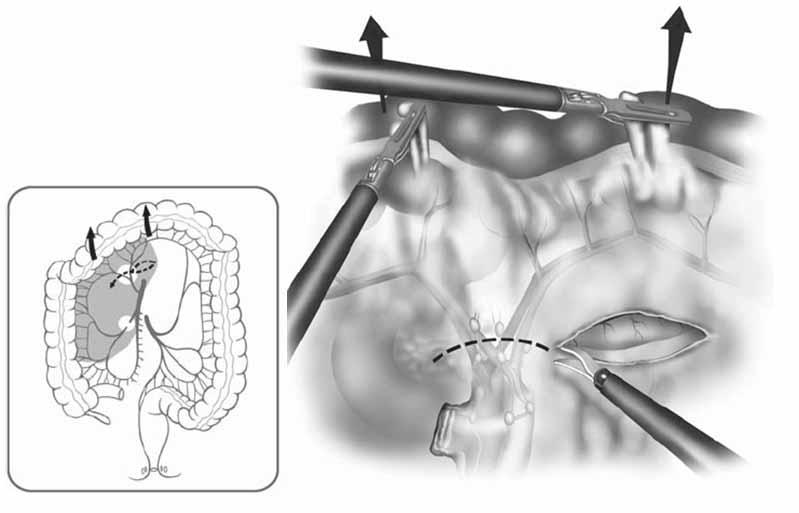 Δεξιά εκτεταμένη κολεκτομή Tεχνική Χειρουργός χαράσει το εγκάρσιο μεσόκολο στα αριστερά του αριστερού κλάδου της μέσης