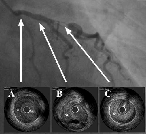 Occasionally, when there is a medial dissection with intramural hematoma formation but without an intimal tear or when there is an entry point but no exit, the diagnosis