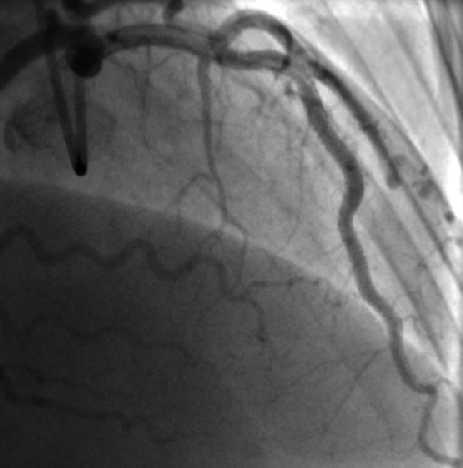 Stent length 72 mm (Promus Premier 3.0X32, 2.