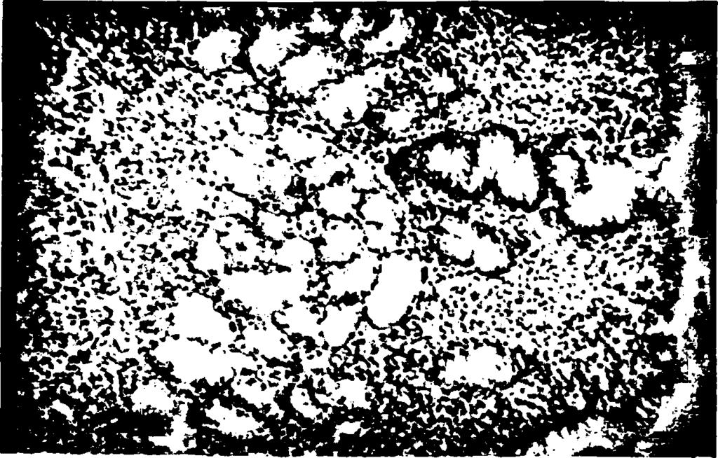 143 Ί * Εικόνα 5. Γαστρική βιοψία. Επιφανειακή ατροφική γαστρίτιδα απότοκος του αποικισμού του γαστρικού βλεννογόνου από το Ελικοβακτηρίδιο του πυλωρού.