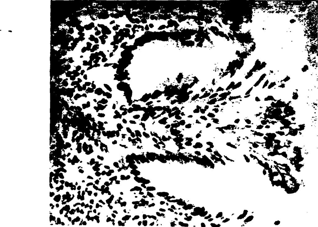 157 % Εικόνα 19. Γαστρική βιοψία. Ασθενής έκφραση της Ε-καντερίνης σε φλεγμαίνοντα ιστό προερχόμενο από το πυλωρικό άντρο.