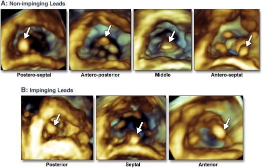 3D Echocardiographic Location of Implantable Device Leads and Mechanism o Associated Tricuspid Regurgitation