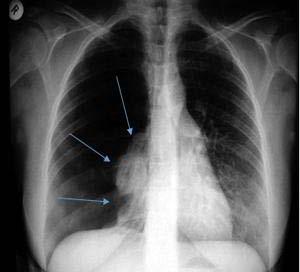 Πνευμοθώρακας υπό τάση CXR: κολόβωμα του πνεύμονα