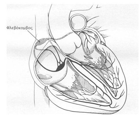 Ο φλεβόκομβος Λειτουργεί σαν φυσικός βηματοδότης της καρδιάς παράγοντας ηλεκτρικά σήματα που προκαλούν τη συστολή του καρδιακού μυός και την άντληση του αίματος.