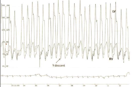 Mixed restrictive cardiomyopathy and constrictive pericarditis Constrictive pericarditis Mixed RC and CP This diagnosis was