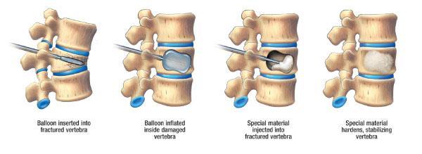 (Balloon kyphoplasty) קיפופלסטיה הנעזרת בבלון זוהי שיטה בה נעשה שימוש במטרה לחזק את עצמות עמוד השדרה, להקל על הכאב ולאפשר להתנועע בקלות.