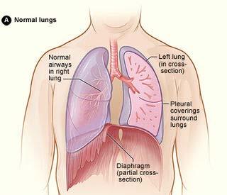 Ασθένειες πνεύμονα σχετιζόμενες με έκθεση σε αμίαντο