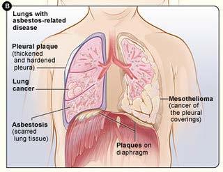 Πνεύμονες μετά από έκθεση σε αμίαντο: Πλάκα υπεζωκότα