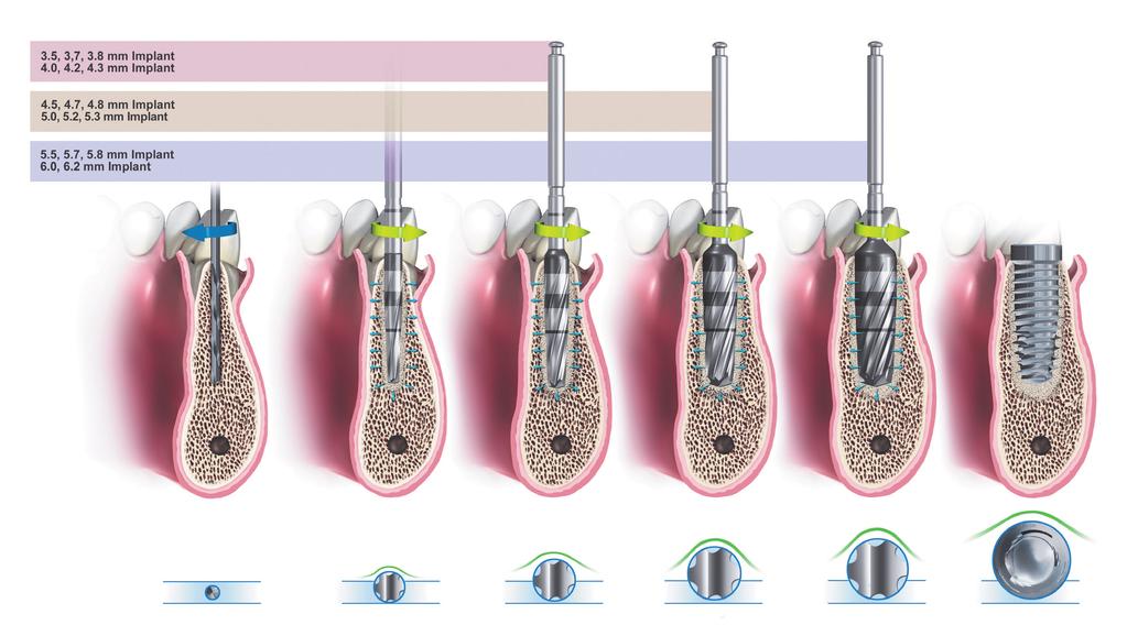 Εμφύτευμα 3,5, 3, 7, 3,8 mm Εμφύτευμα 4,0, 4,2, 4,3 mm Εμφύτευμα 4,5, 4,7, 4,8 mm Εμφύτευμα 5,0,