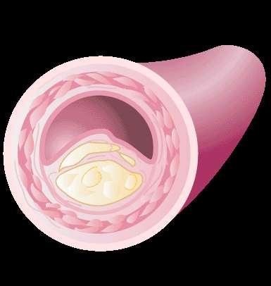 Insulin resistance IR Hyperglycemia