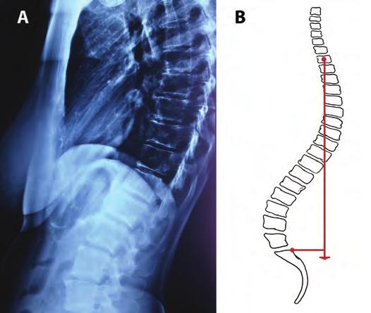Διάχυτη Ιδιοπαθής Σκελετική Υπερόστωση-DISH: Δ. Πάλλης, Ι. Τριανταφυλλόπουλος Εικόνα 5. Οβελιαία ισορροπία και απόσταση SVA (Sagittal Vertical Axis) σε φυσιολογικά κυρτώματα της σπονδυλικής στήλης.