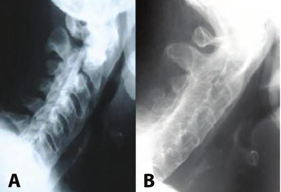 Κεφάλαιο 10: Διαφορική διάγνωση Εικόνα 14. Α. Πλάγια ακτινογραφία αυχενικής μοίρας της σπονδυλικής στήλης σε ασθενή με νόσο DISH.