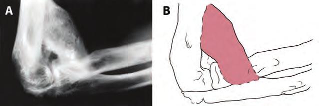 Διάχυτη Ιδιοπαθής Σκελετική Υπερόστωση-DISH: Δ. Πάλλης, Ι. Τριανταφυλλόπουλος Εικόνα 18. Α. Έκτοπη οστεοποίηση άρθρωσης αγκώνα 78. Β. Σχηματική απεικόνιση έκτοπης οστεοποίησης άρθρωσης αγκώνα.
