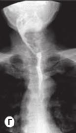 Πλάγια ακτινογραφία αυχενικής μοίρας σπονδυλικής στήλης όπου απεικονίζονται μεγάλα οστεόφυτα στο πρόσθιο τμήμα της. Β.