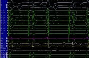 Holter: 19.