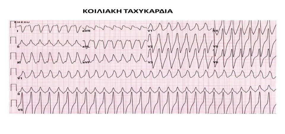 Εικόνα 5. Ηλεκτροκαρδιογραφική απεικόνιση κοιλιακής μαρμαρυγής (http://anesthesia.gr/temp/wp-content/uploads/2013/11/ceea%20- %202o%20Seminario%20(kardia)%20-%20BOOK%202013.pdf, ημ.