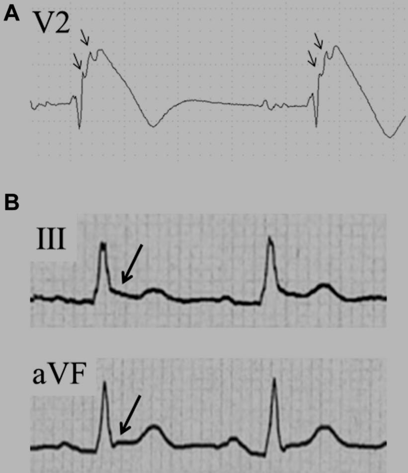 Electrocardiographic Parameters and Fatal Arrhythmic Events in Patients With Brugada Syndrome