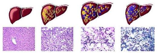 DM - Adiposity in the development of NASH Adipose Insulin Leptin Adiponectin Fatty acids Liver Normal Steatosis (fatty liver) Steatohepatitis