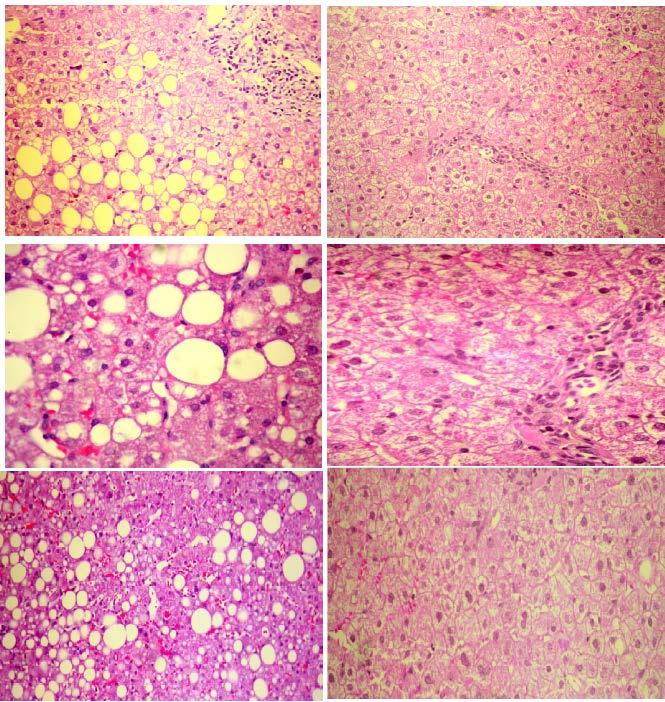 Resolution of non-alcoholic steatohepatitis by rosuvastatin monotherapy in patients with metabolic