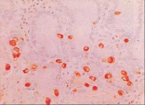 Εικόνα 1.30 Εντεροενδοκρινή κύτταρα πυλωρικού άντρου με ανοσοϊστοχημική χρώση γαστρίνης (Πηγή:https://www.google.gr/search?