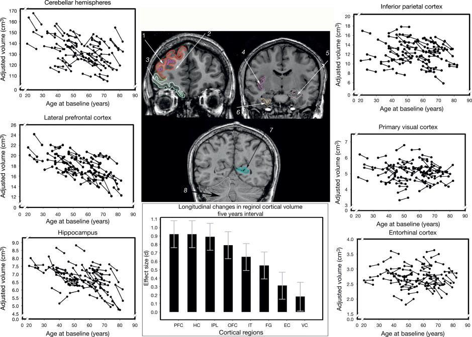 Differential brain shrinkage over 5 years in healthy