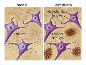 Alzheimerjeva bolezen Nevrodegenerativna bolezen, pogosta pri starejših ljudeh.
