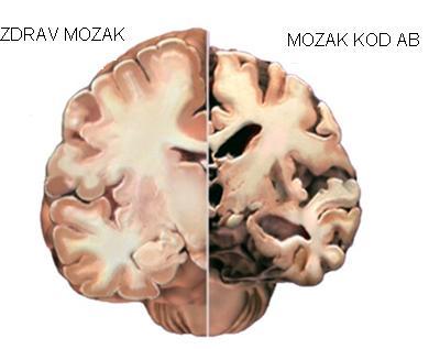Mozak bolesnika sa Alzheimerovom bolesti izgleda difuzno atrofičan, dok je ukupna težina mozga smanjena za 20 i više posto.