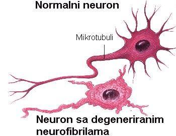 Glavne patohistološke promjene kod Alzheimerove bolesti su ekstracelularni depoziti amiloida-β (Aβ ) amiloidni ili senilni plakovi (SP) i