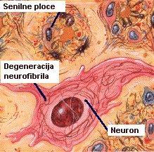 Neurofibrilarne nakupine se sastoje od parnih helikalnih filamenata, čiju strukturu čini za mikrotubule vezan protein u