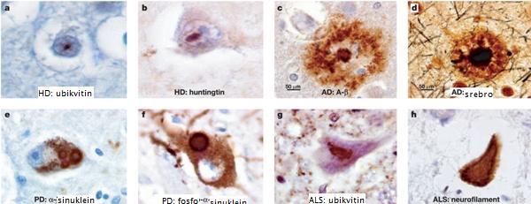 Proteini uključeni ustvaranje agregata su β-amiloid, tau protein, α- sinuklein, parkin protein, prionski