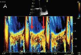 Pitfalls in the quantitative echo assessment of FMR Variation of the PISA