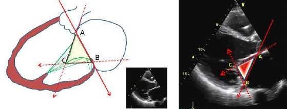 The coaptation triangle