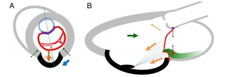 Phenotypes of FMR: Asymmetric Model an inferoposterior myocardial infarction outpouching of the LV myocardium displacement of the posteromedial PM increase tethering forces on