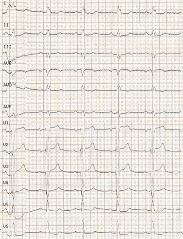 ΗΚΓ: SR, LBBB Ακτινογραφία θώρακος: αυξηµένος ΚΘΔ, άµβλυνση πλευροδιαφραγµατικών