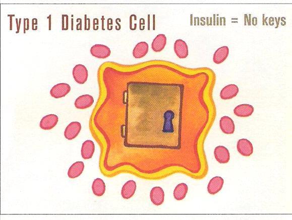 ΣΔ1 vs ΣΔ2 Απουσία ινσουλίνης (δεν υπάρχει κλειδί)
