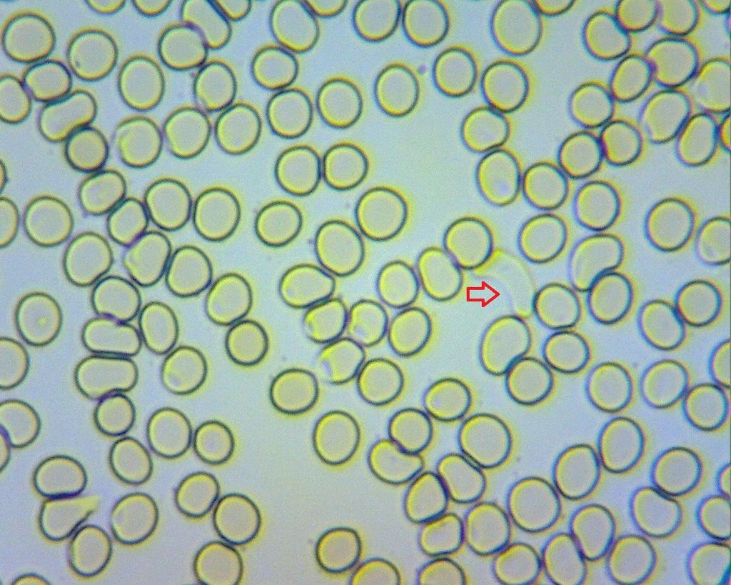38 έχουμε να κάνουμε για το συγκεκριμένο δείγμα είναι η εμφάνιση μικρού ποσοστού ερυθροκυττάρων τα οποία έχουν χάσει πλήρως το κυταρρόπλασμά τους, τα οποία ονομάζονται φαντάσματα (διεθνής