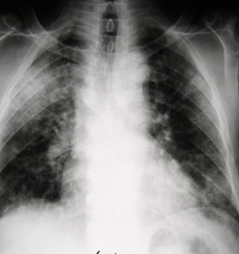 εκδθλϊςεισ Χωρίσ φάρμακα PO2 58 mmhg